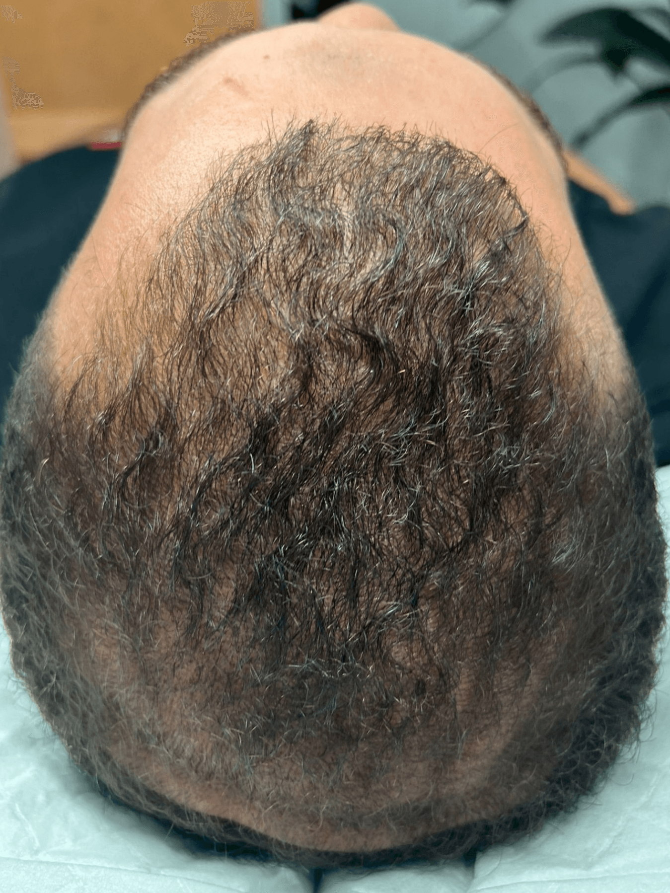 After PRP treatment - Patient 1 — Crown restoration after 1 PRP treatment
