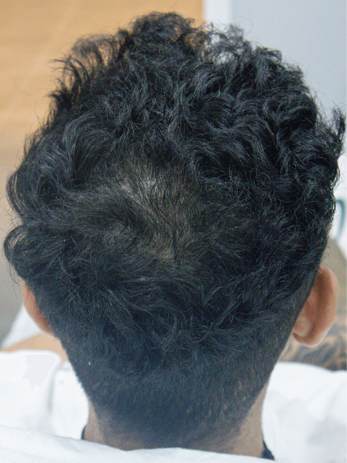 After PRP treatment - Patient 2 — Crown density improvement after 1 PRP treatment