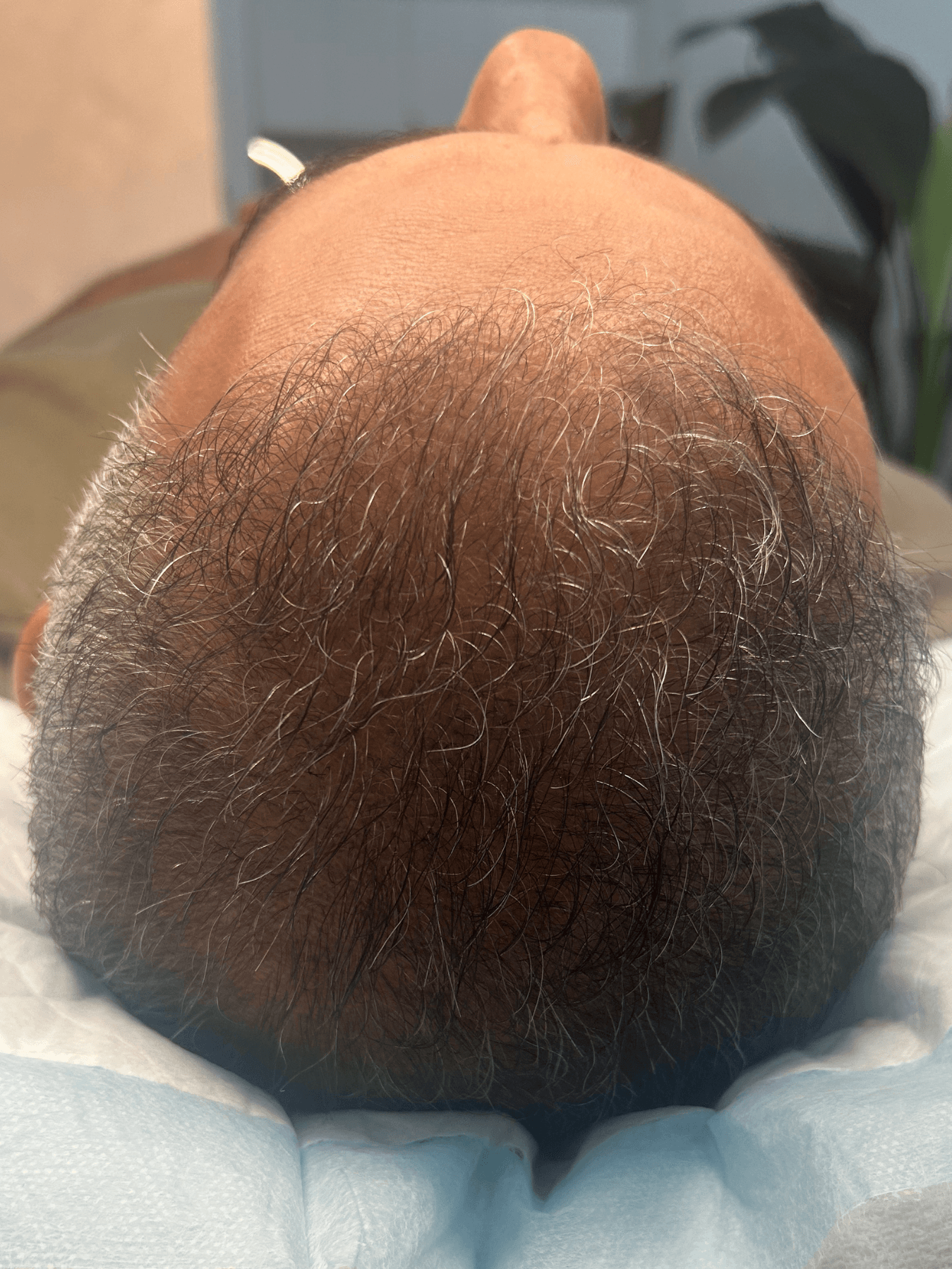 After PRP treatment - Patient 3 — Overall thickness improvement after 1 PRP treatment