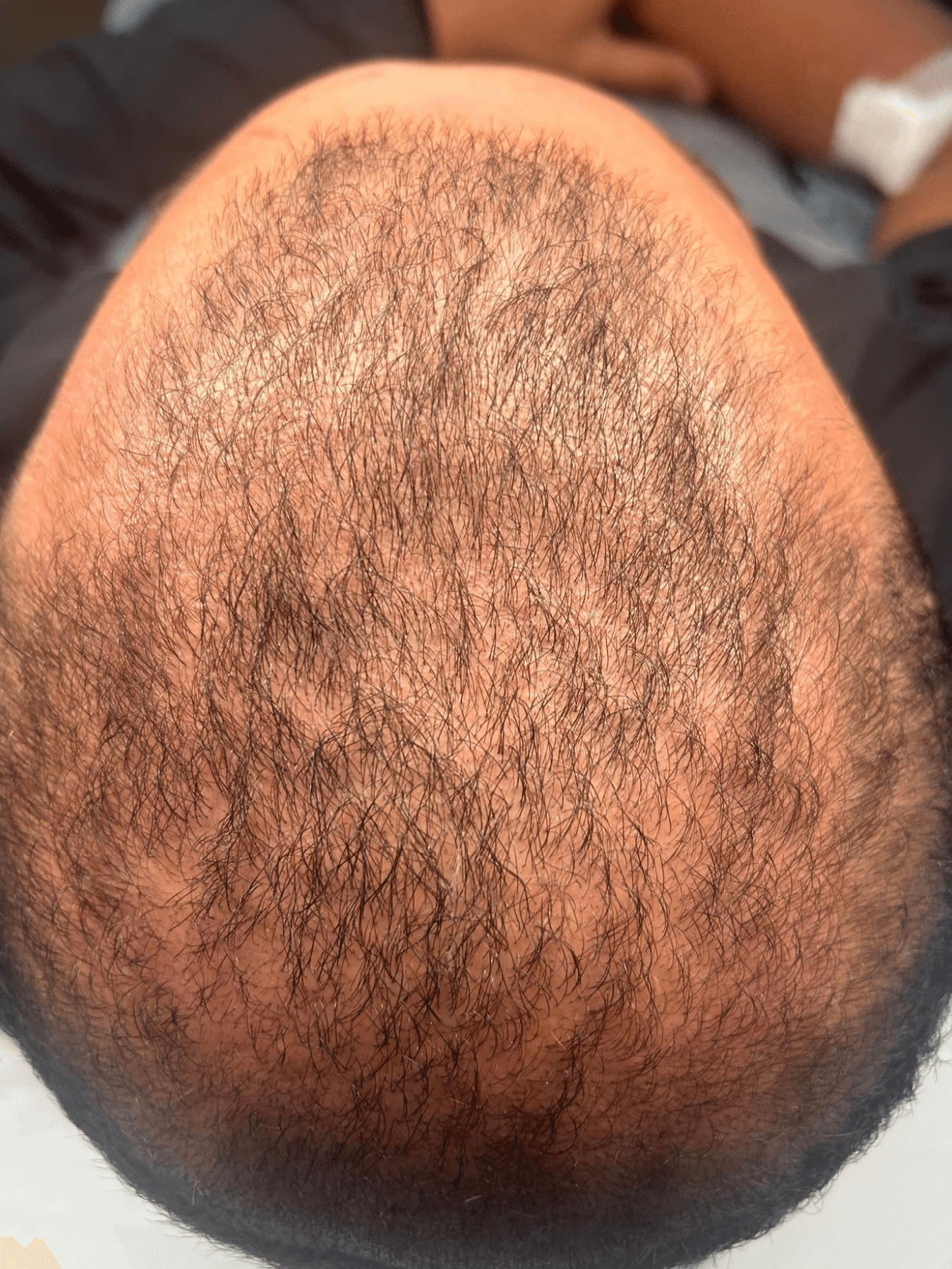 Before PRP treatment - Patient 1 — Crown restoration after 1 PRP treatment