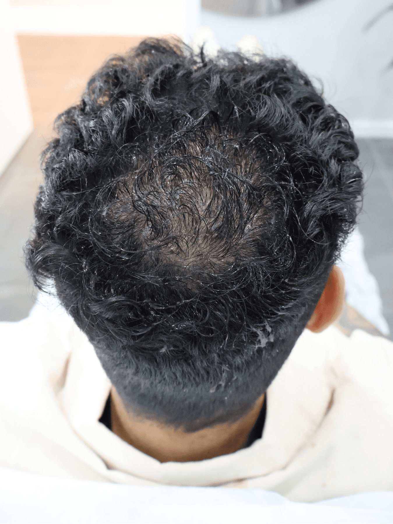 Before PRP treatment - Patient 2 — Crown density improvement after 1 PRP treatment