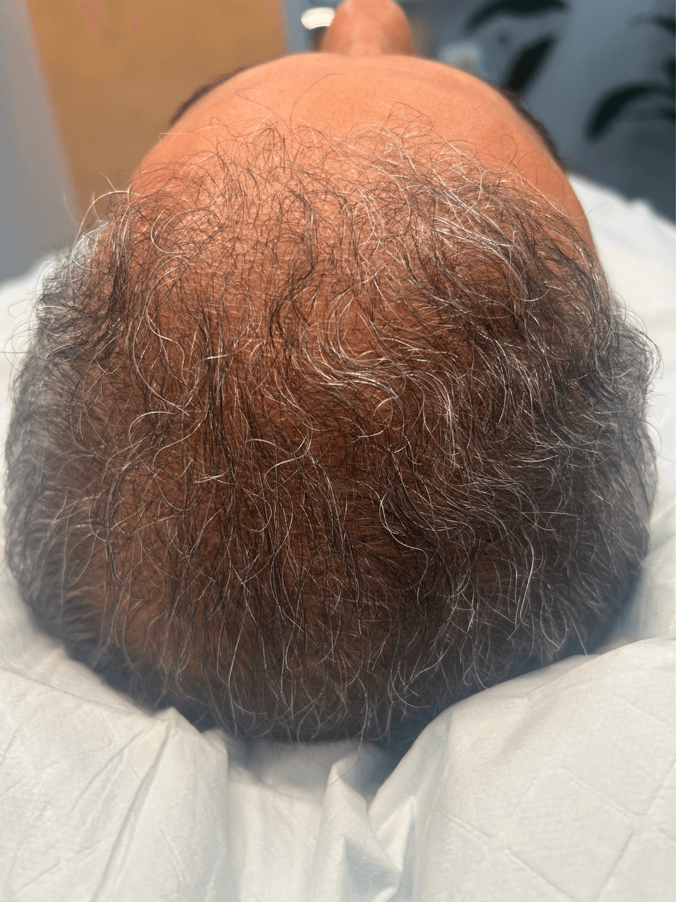 Before PRP treatment - Patient 3 — Overall thickness improvement after 1 PRP treatment